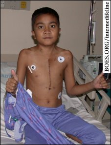 Danlee Suangco Serrano, 13, with his long scar after the lifesaving action in international cooperation.