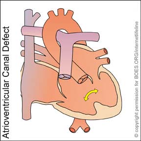 ACD - Atrioventricular Canal Defect. Congenital Heart Disease