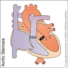 AS - Aortic Stenosis. Congenital Heart Defect