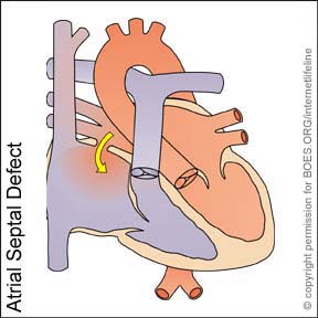 ASD - Atrial Septal Defect. Congenital Heart Disease