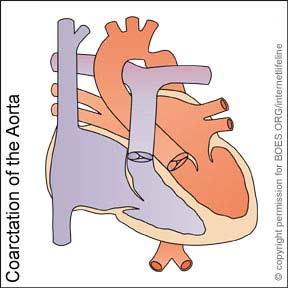 COA - Coarctation of the Aorta. Congenital Heart Defect
