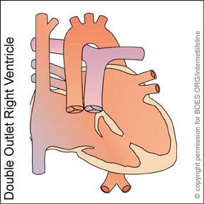 DO - Double Outlet Right Ventricle. Congenital Heart Defect