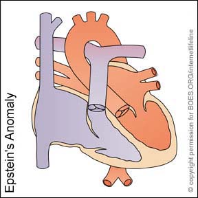 EA - Epstein's Anomaly. Congenital Heart Disease