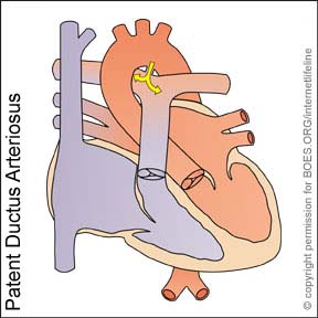 PDA - Patent Ductus Arteriosus. Congenital Heart Disease