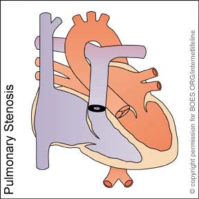PS - Pulmonary Stenosis. Congenital Heart Disease