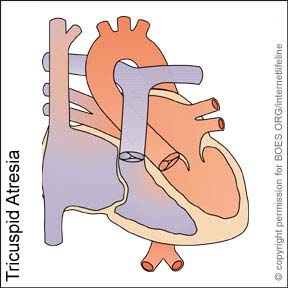 TA - Tricuspid Atresia. Congenital Heart Disease