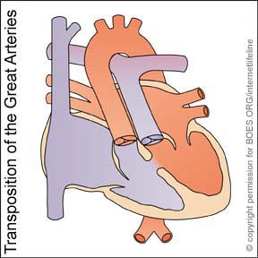 TGA -Transposition of the Great Arteries. Congenital Heart Disease