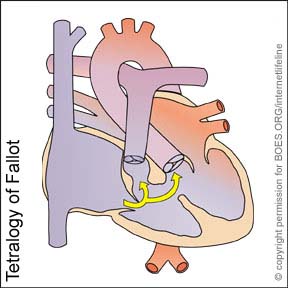 TOF - Tetralogy of Fallot. Congenital Heart Disease